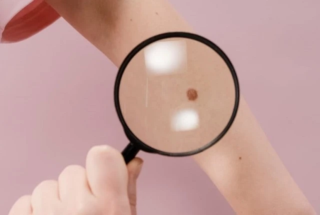 Preventivní vyšetření melanomu
